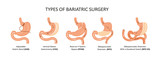Types of bariatric surgery. Stomach reduction