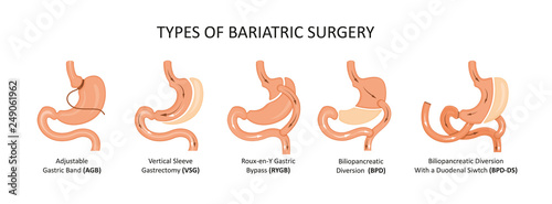 Types of bariatric surgery. Stomach reduction photo