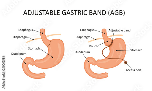 Adjustable gastric band (AGB)