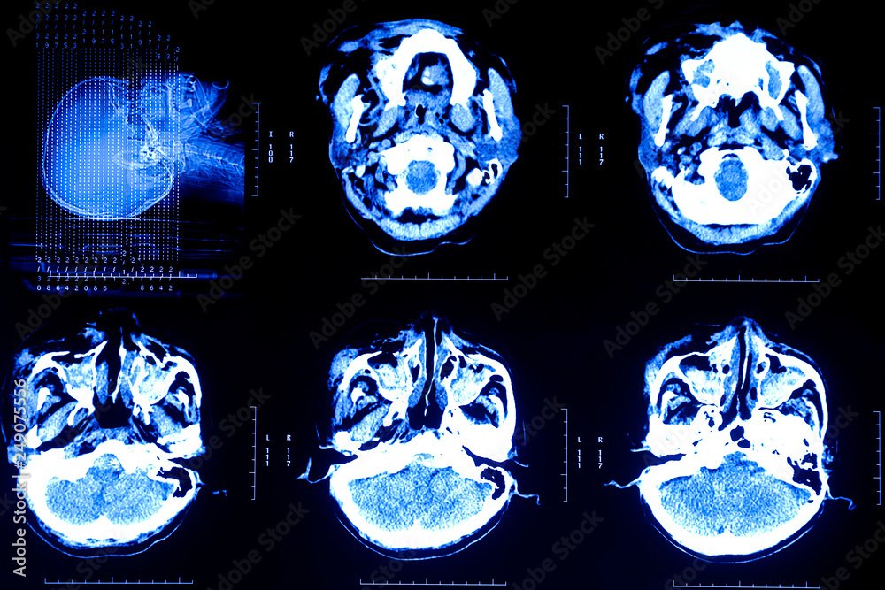 MRI of the brain.Xray film of the brain computed tomography on back