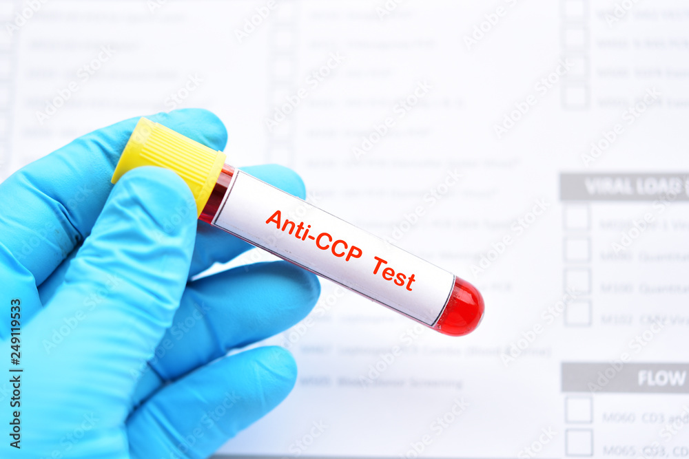 Fototapeta premium Blood sample tube for anti-CCP test, diagnosis for rheumatoid arthritis disease