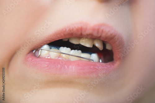 Photo of a little girl's mouth with an orthodontic appliance and crooked teeth.