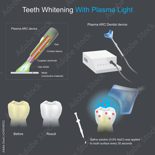 Teeth Whitening With Plasma Light.