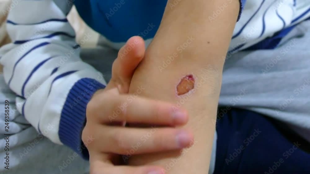 arm injured child, bicycle accidents and arm injured child, close-up crustacean wound 