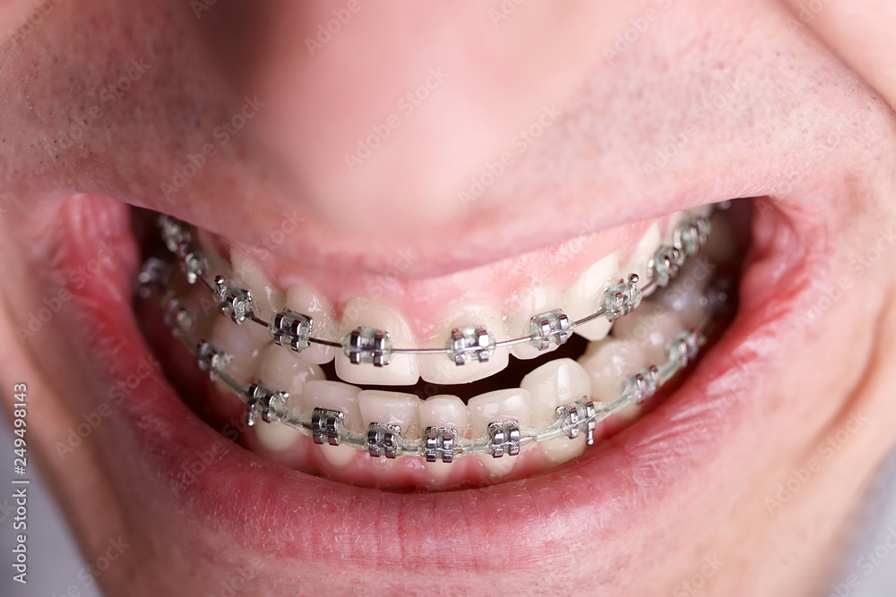 Metal orthodontic braces on crooked ugly teeth closeup. Ugly smile