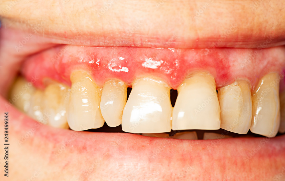 Фотография teeth with periodontitis close up