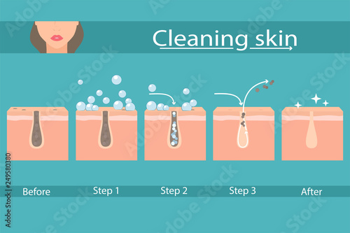 Facial skin care, pore cleaning. Cleansing stages on clogged face. Skin cleaning steps. Vector illustration.