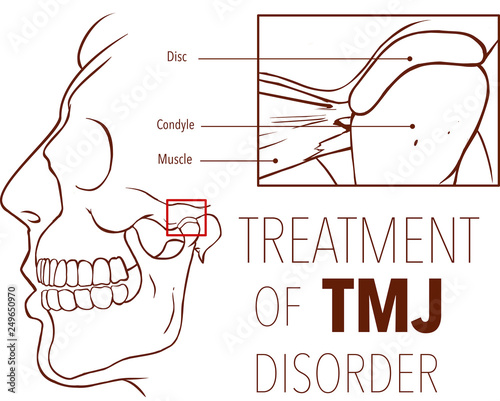 Vector illustration  of treatment of tmj disorder photo