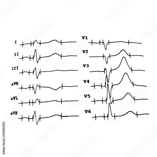 Cardiogram. Heartbeat. Schedule. Vector illustration on isolated background © timonina