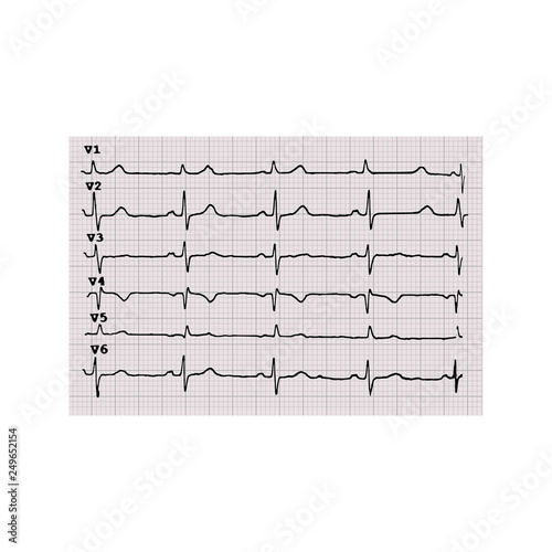 Cardiogram. Heartbeat. The graph on graph paper. Vector illustration on isolated background photo