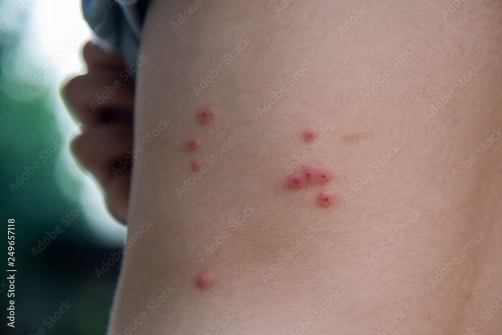 Insect sting allergy on child body. Insect sting allergy on child body.