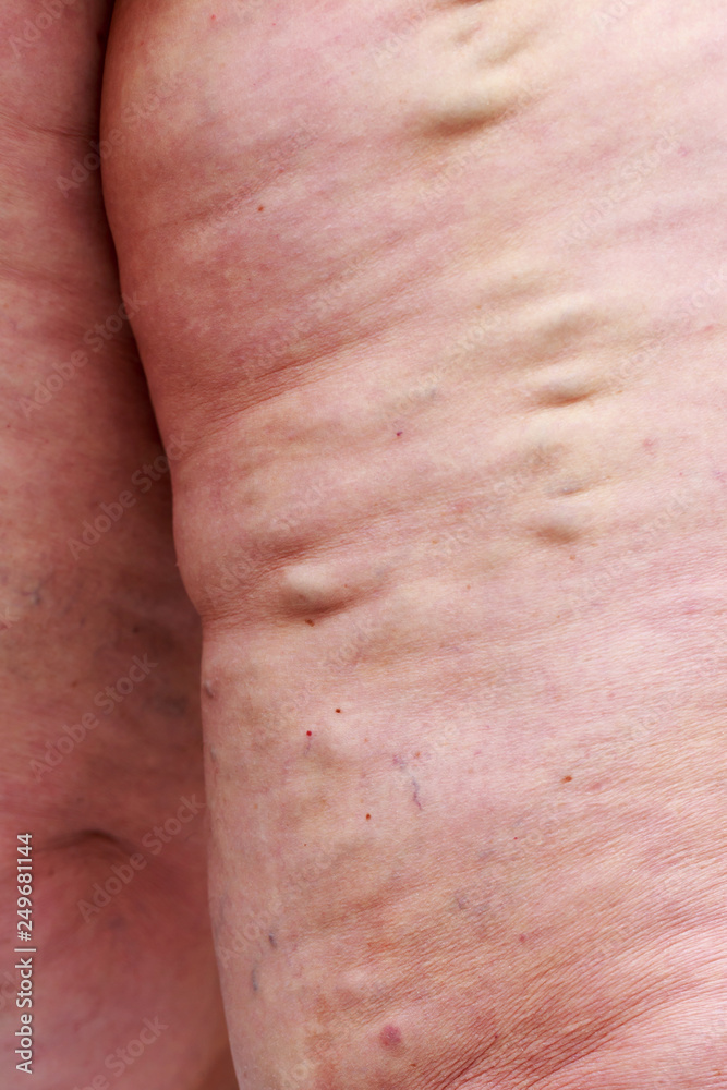 Fototapeta premium The varicose veins