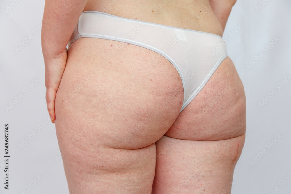 28 year old Caucasian overweighted woman in lingerie shows places with  excess fat, irritation and cellulite on the hips,buttocks and abdomen .  Concept for medicine and cosmetology Photos | Adobe Stock