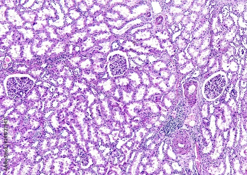 Histology of human tissue, show arteriolar hyaline degeneration of kidney as seen under the microscope, 10x zoom