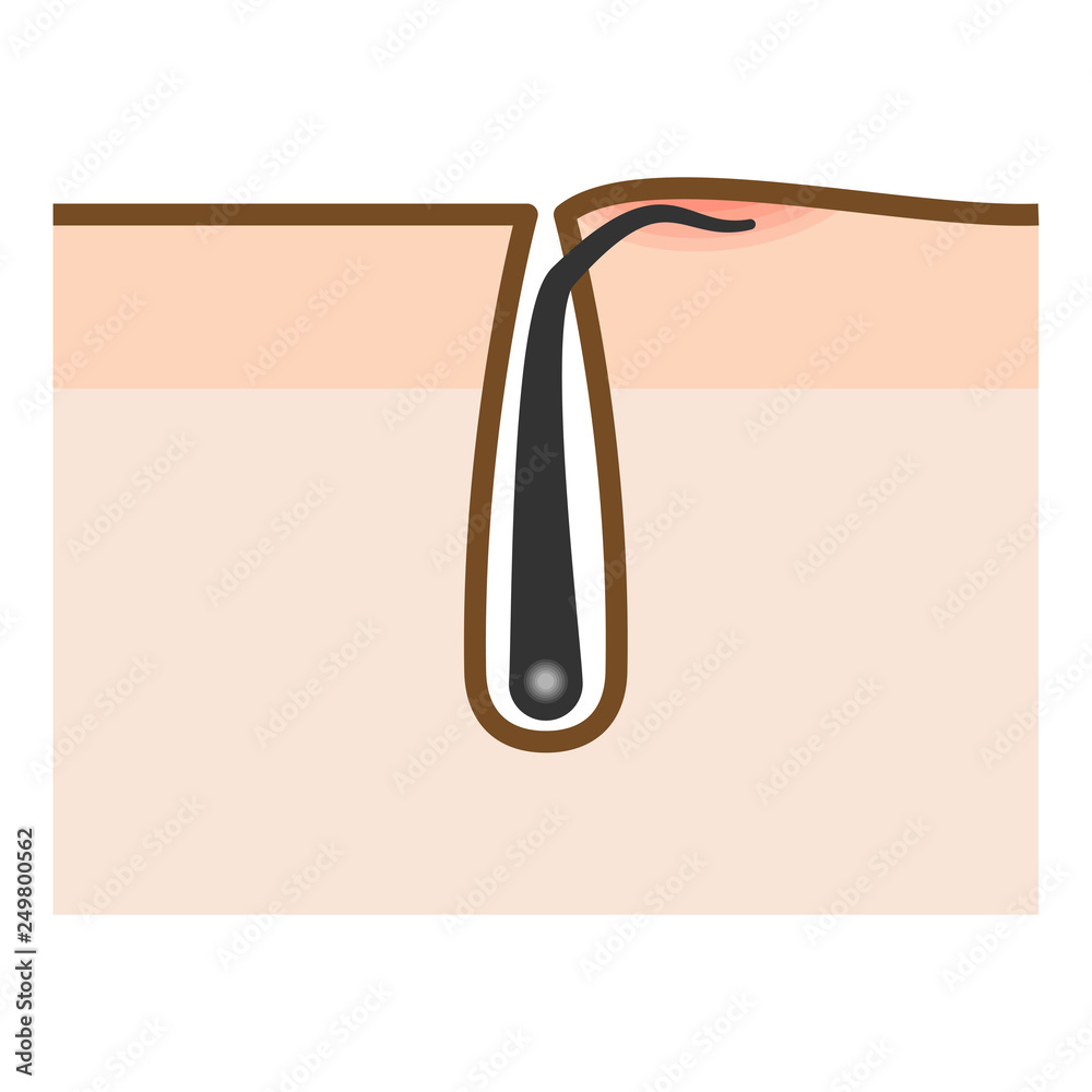 ムダ毛処理 脱毛トラブル埋没毛 埋もれ毛 のイラスト Stock Illustration Adobe Stock