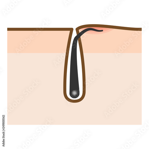 埋もれ毛 Images Browse 31 Stock Photos Vectors And Video Adobe Stock