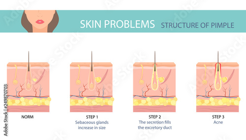 Stages of the acne formation in the human skin. Skin layer with acne. Vector illustration.