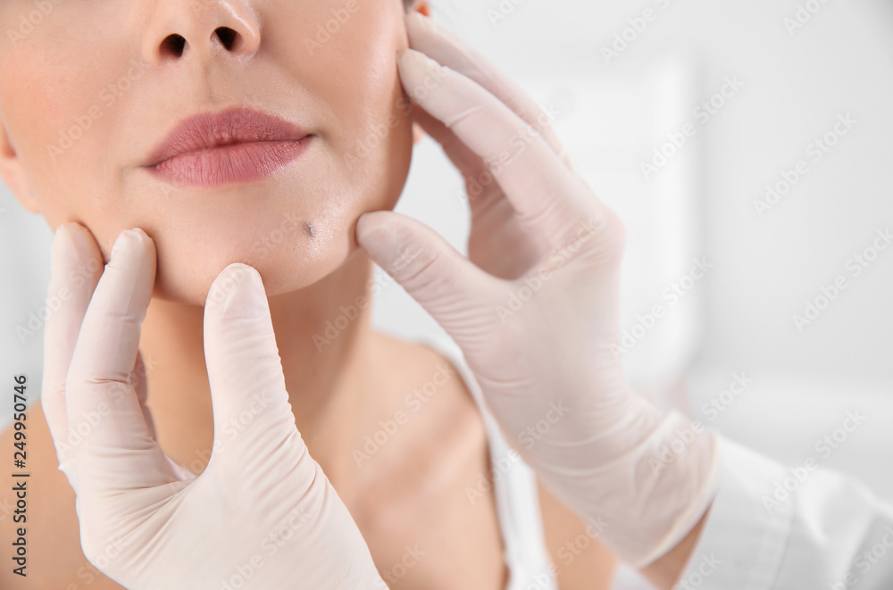 Dermatologist examining patient's birthmark in clinic, closeup Dermatologist examining patient's birthmark in clinic, closeup