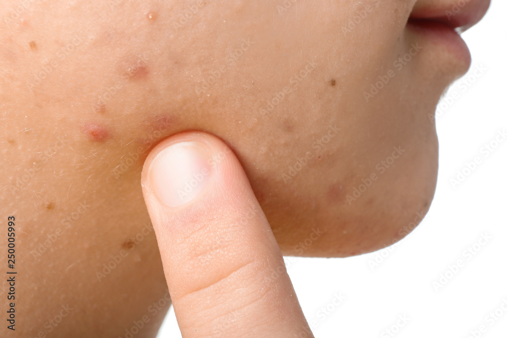 Teenager with acne problem, closeup Teenager with acne problem, closeup