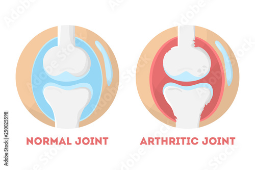 Normal and arthritic human joint anatomical infographic