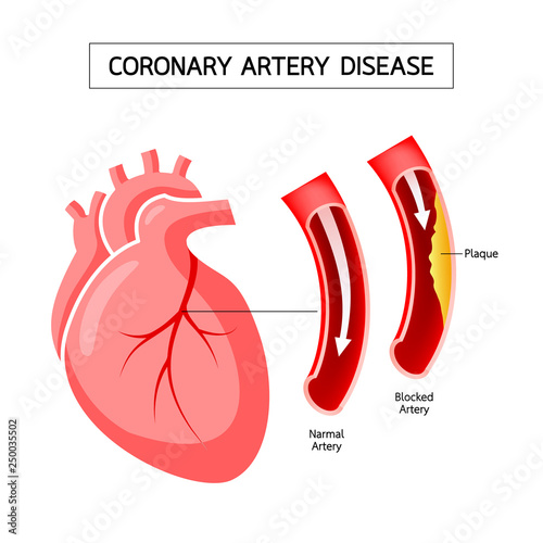 Human heart with Coronary Artery Disease info graphic. Blocked artery, heart awareness concept. Illustration isolated on white background.