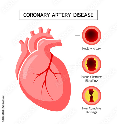 Human heart with Coronary Artery Disease info graphic. Blocked artery, heart awareness concept. Illustration isolated on white background.