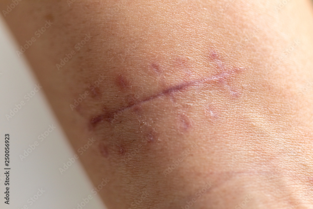A scar is an area of fibrous tissue that replaces normal skin after an injury on skin. A scar is an area of fibrous tissue that replaces normal skin after an injury on skin.