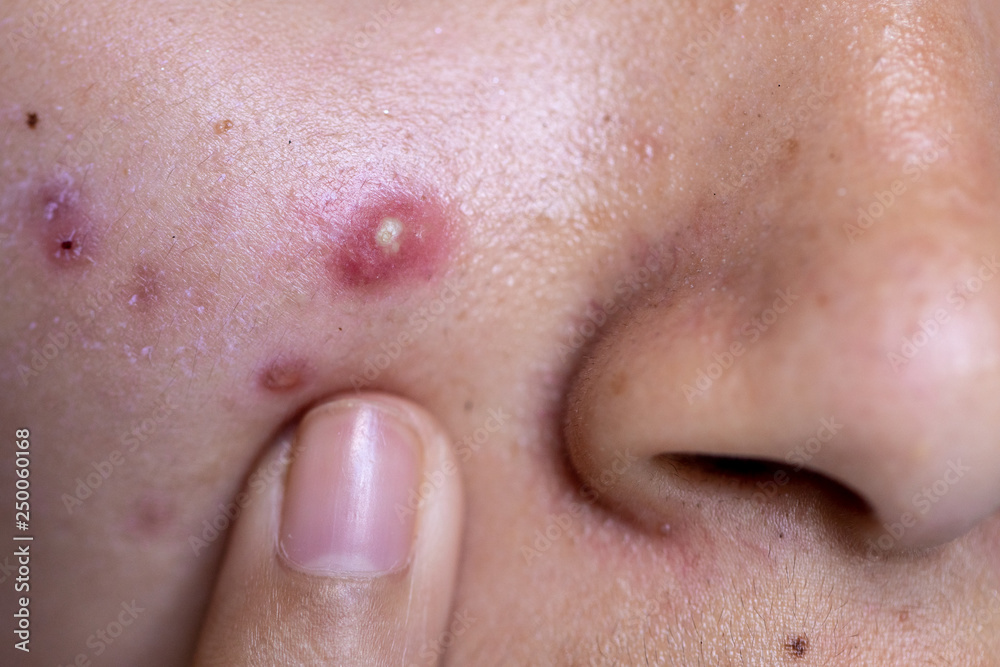 Backgrounds of lesions skin caused by acne on the face in the clinic. Backgrounds of lesions skin caused by acne on the face in the clinic.