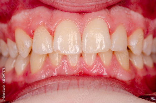 closeup of healthy frontal teeth