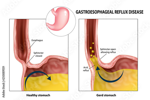 Gastroesophageal reflux disease (Gerd or Heartburn).  Acid reflux photo