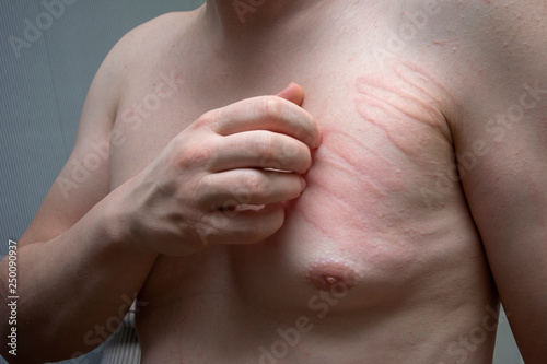 Great irritation on the skin. A strong urticaria on nervous soil. Very sensitive male skin. photo