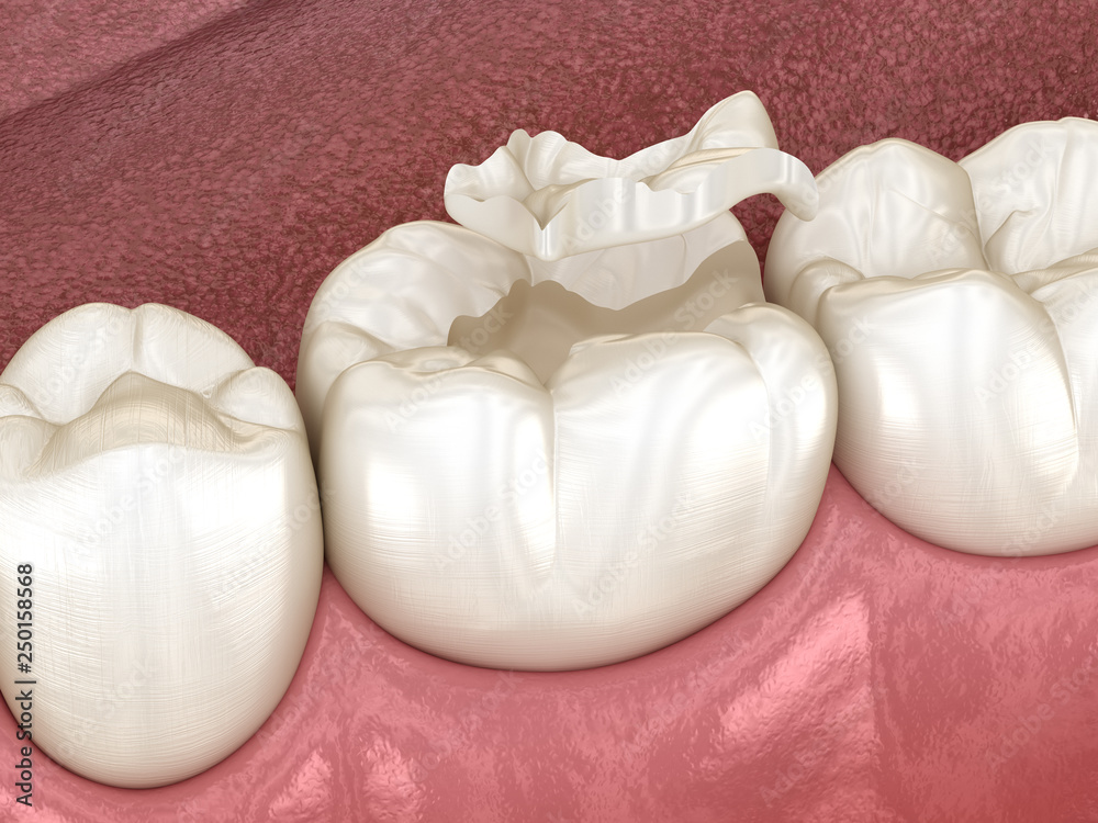 Inlay ceramic crown fixation over tooth. Medically accurate 3D illustration of human teeth treatment