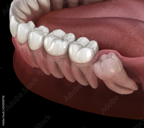 Fotografija Healthy teeth and wisdom tooth with mesial impaction