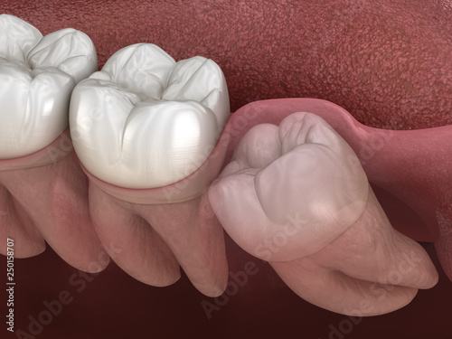 Konstfotografi Healthy teeth and wisdom tooth with mesial impaction