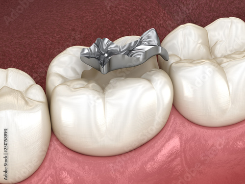 Fotografie Inlay silver crown fixation over tooth