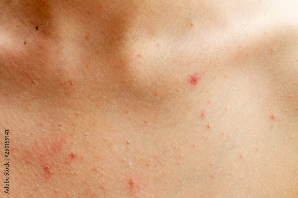 Fototapeta premium pimples skin. female body with skin in pimples