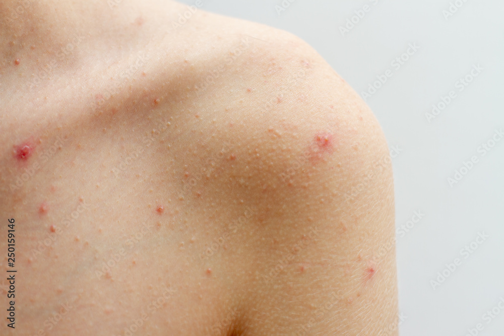 female body with skin in pimples female body with skin in pimples