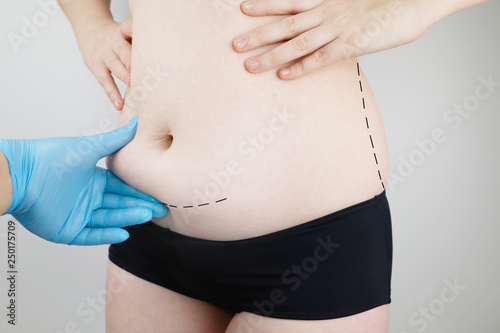 Abdominoplasty and torsoplasty: abdominal liposuction and removal of the apron. The patient at the reception at the plastic surgeon photo