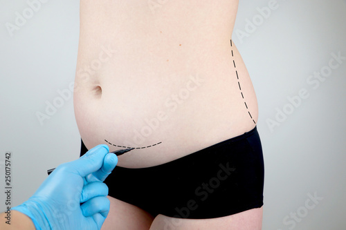 Abdominoplasty and torsoplasty: abdominal liposuction and removal of the apron. The patient at the reception at the plastic surgeon photo