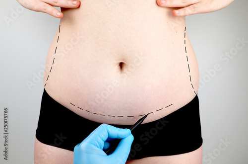 Abdominoplasty and torsoplasty: abdominal liposuction and removal of the apron. The patient at the reception at the plastic surgeon