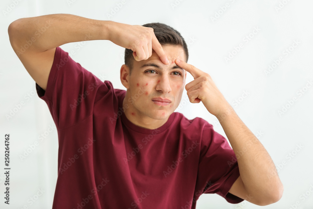 Portrait of young man with acne problem squishing pimples at home Portrait of young man with acne problem squishing pimples at home