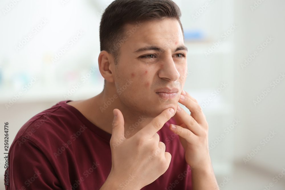 Portrait of young man with acne problem squishing pimples at home