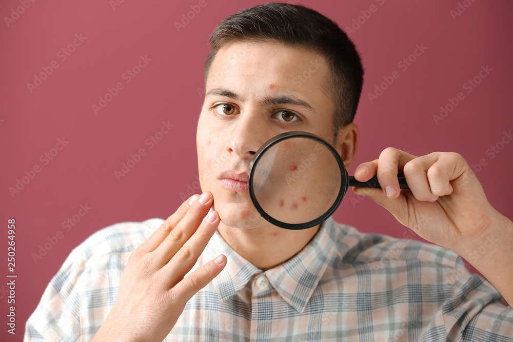 Portrait of young man with acne problem and magnifier on color background Portrait of young man with acne problem and magnifier on color background