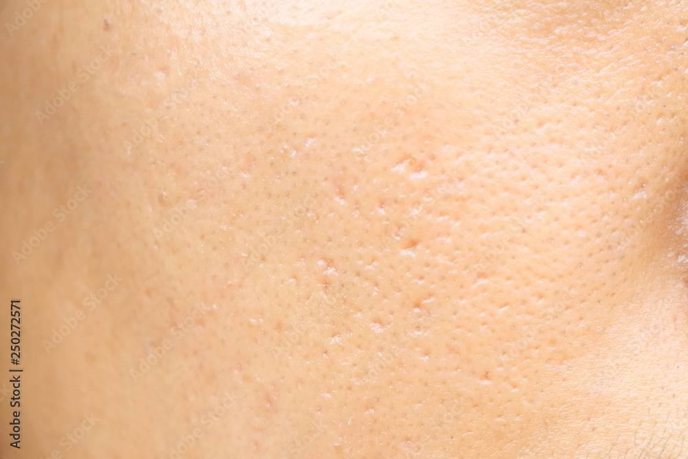 close up wide pores on oily face skin of asia woman close up wide pores on oily face skin of asia woman