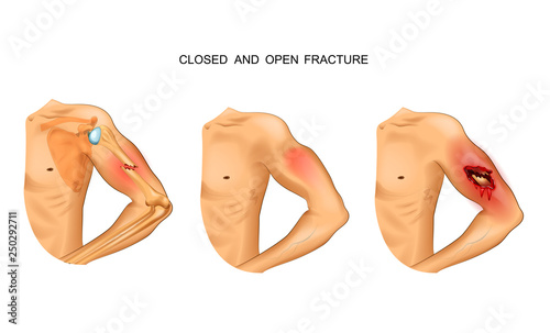 Fotografia open and closed fracture