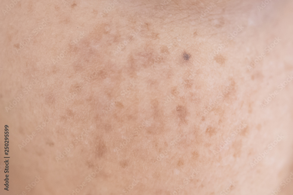 freckle on asian woman skin