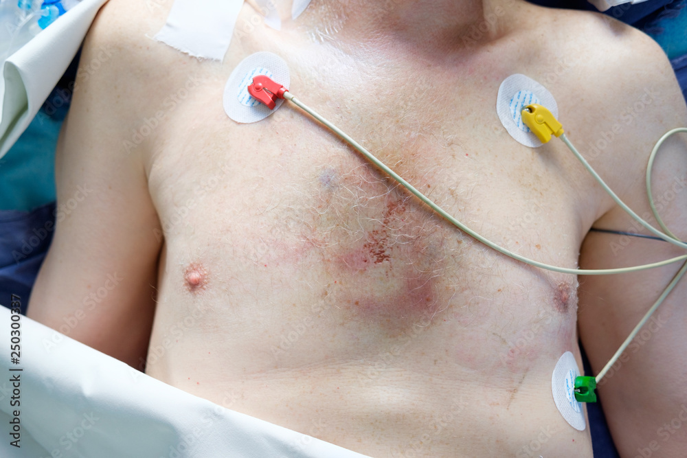 Complications of chest compression. Hematoma on the chest after