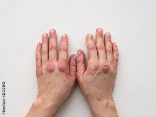 Psoriasis skin. Closeup of rash and scaling on the patient's skin. The concept of chronic disease treatment. Dermatological problems. Hard, horny and cracked skin in woman's hands. Dry skin. Isolated.