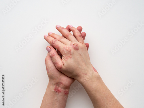 Psoriasis skin. Closeup of rash and scaling on the patient's skin. The concept of chronic disease treatment. Dermatological problems. Hard, horny and cracked skin in woman's hands. Dry skin. Isolated.