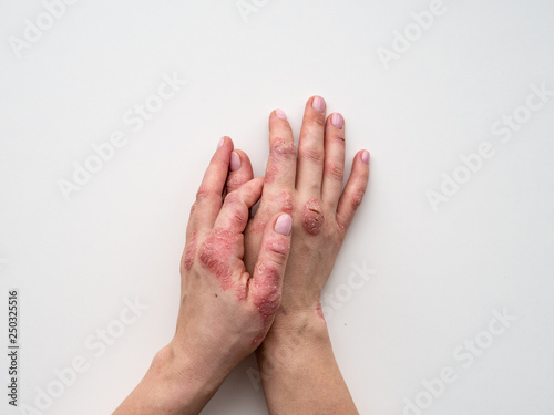 Psoriasis skin. Closeup of rash and scaling on the patient's skin. The concept of chronic disease treatment. Dermatological problems. Hard, horny and cracked skin in woman's hands. Dry skin. Isolated.